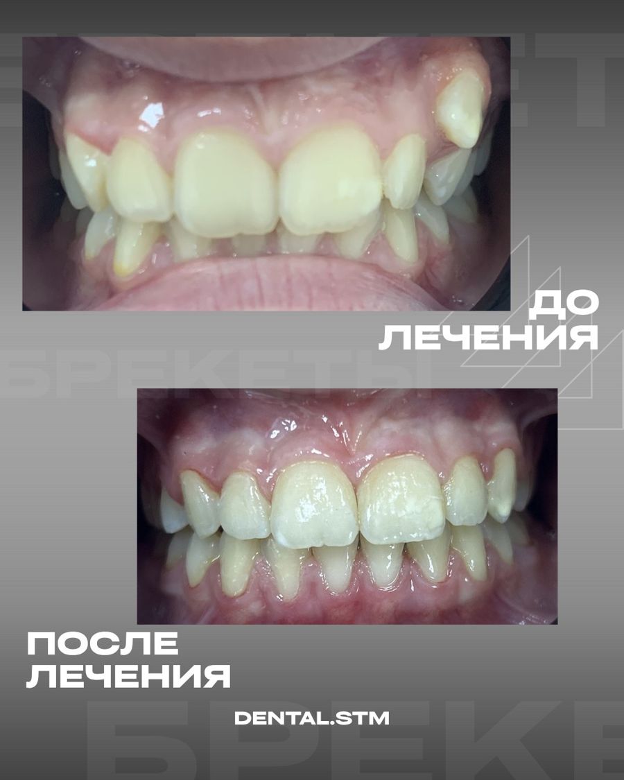 Брекеты · случай 2 — Ортодонтия, клиника Денталь, Кострома