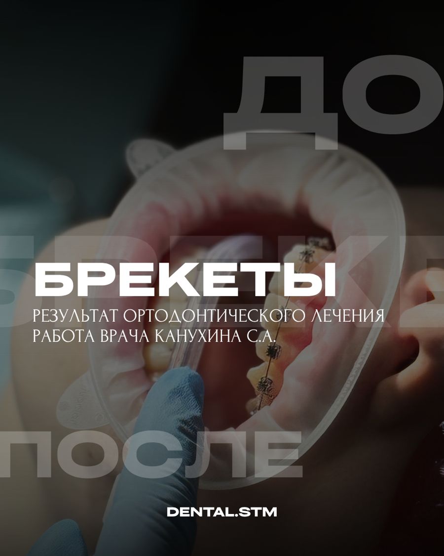 Брекеты — Ортодонтия, клиника Денталь, Кострома