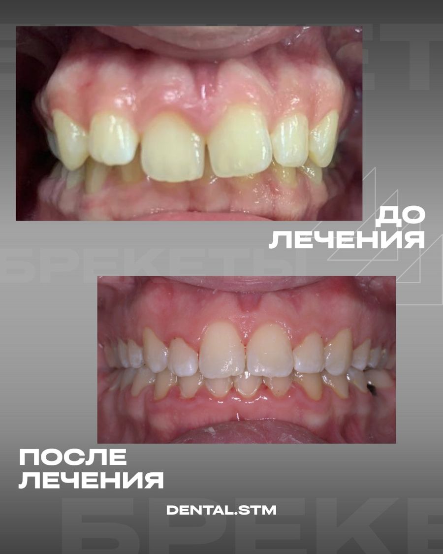 Брекеты · случай 4 — Ортодонтия, клиника Денталь, Кострома