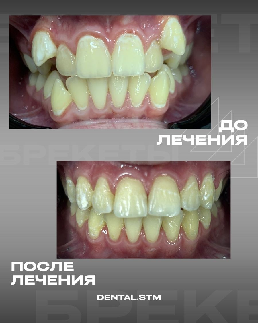 Брекеты · случай 3 — Ортодонтия, клиника Денталь, Кострома